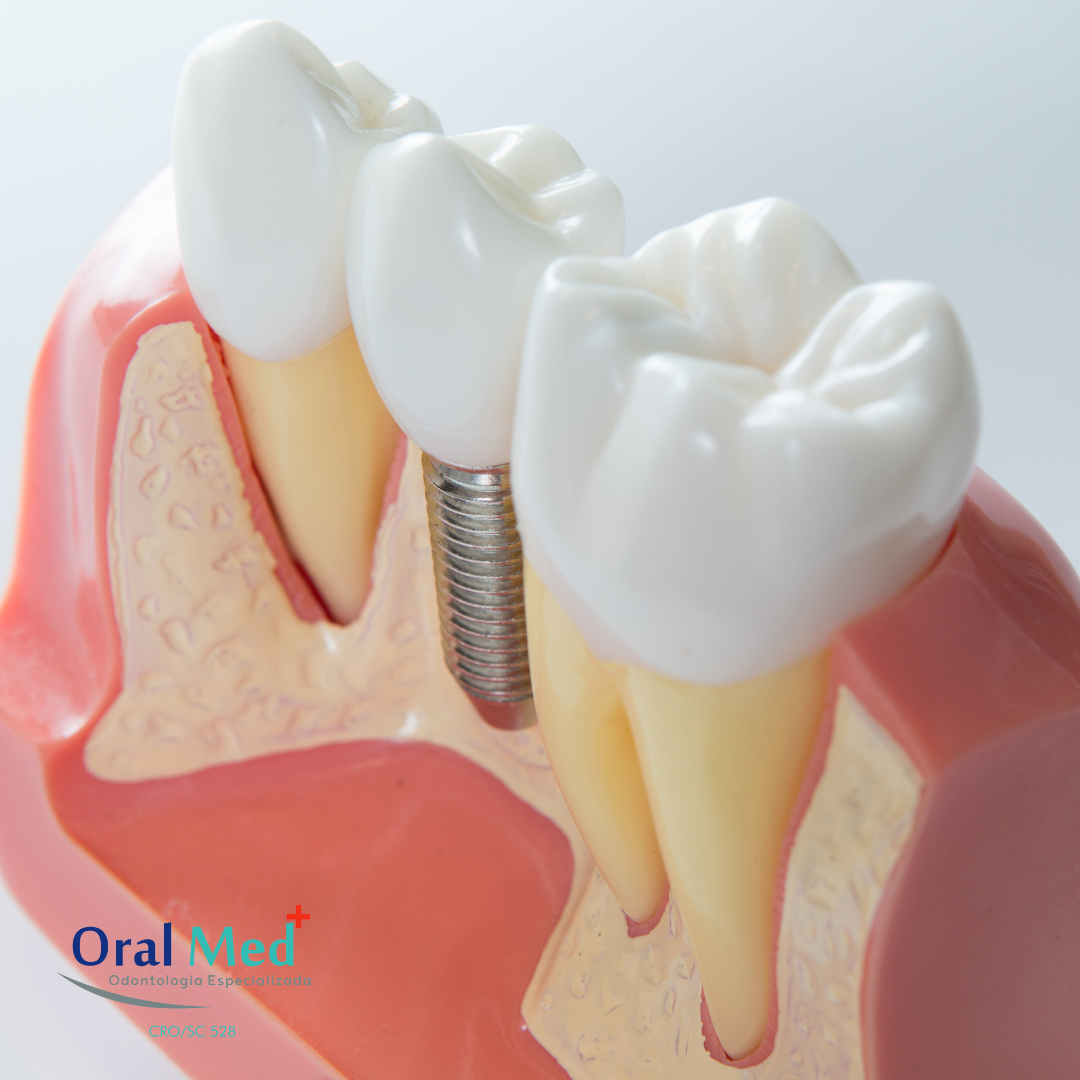 Pr Teses E Implantes Oralmed Odontologia Especializada