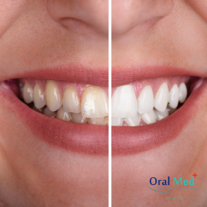 Clareamento dental a laser - antes e depois