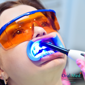 Clareamento dental a laser - processo