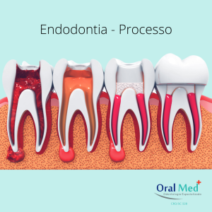 Endodontia - Esquema