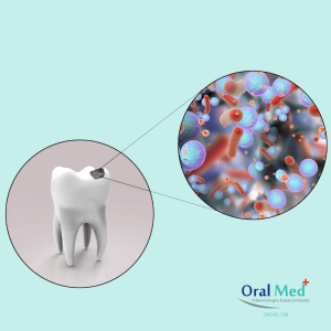 Cárie Dental - Esquema