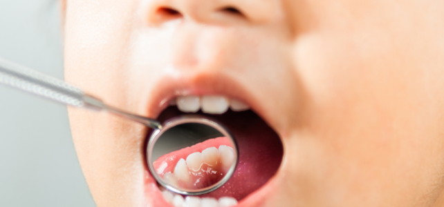 Cárie Dental pode ocorrer em todas as idades.