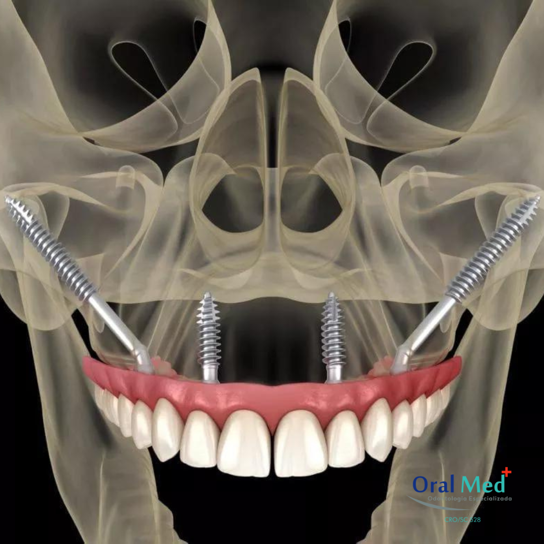 Como é o implante zigomático? - OralMed Odontologia Especializada