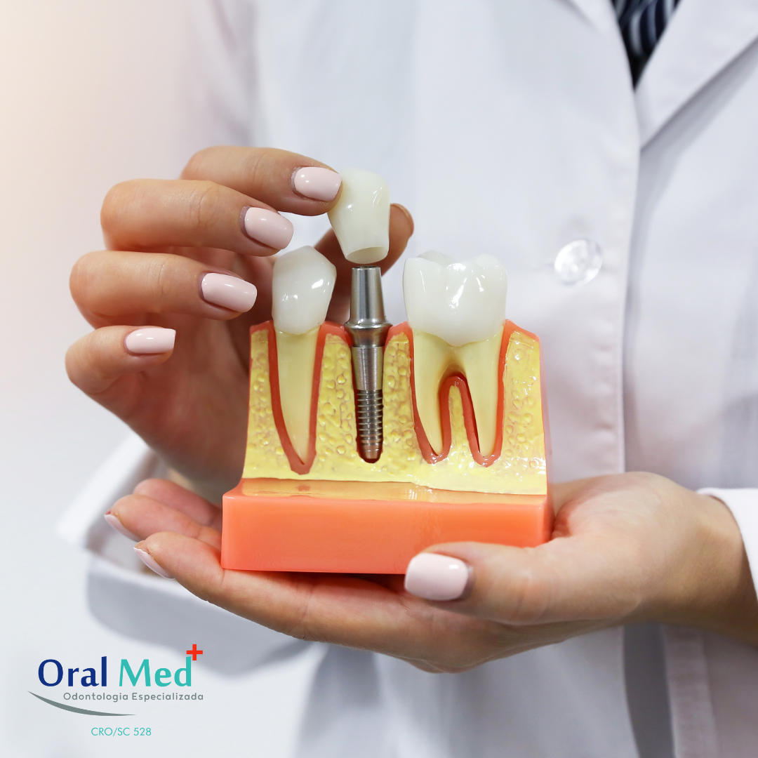 Como é feito o tratamento ortodôntico com implante dentário? – Oral Dente