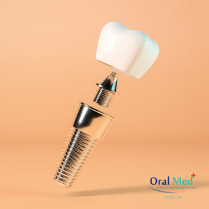 As etapas do implante dentário