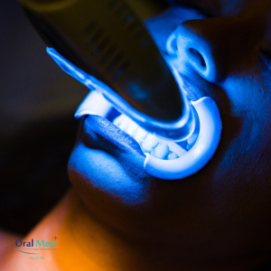 Mitos e verdades sobre o clareamento dental a laser